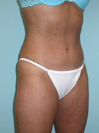 Abdominoplasty and Liposuction after 148592