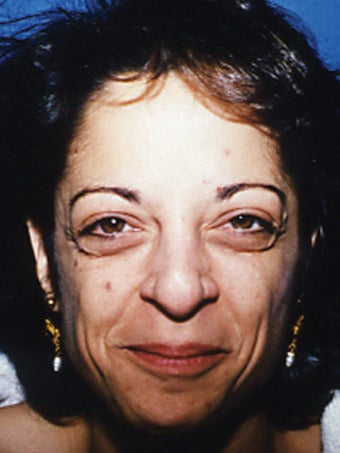Upper and Lower Blepharoplasty before 249789