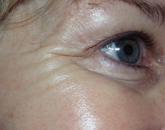 Botox to the crow's feet before 240878