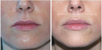 Juvederm: Subtle Lip Enhancement before 355964