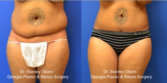 Mini Tummy Tuck before 568398