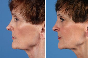 Juvederm Plus 356494