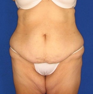 Tummy Tuck before 312327
