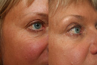 Non-Invasive Wrinkle Treatment before 595545