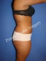 Liposuction 632168