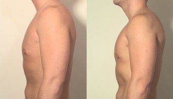 Pectoral implants after 161537
