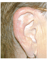 Skin cancer reconstruction on ear after 84497