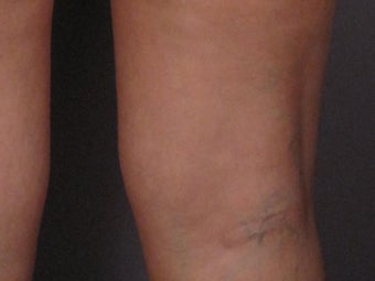 Sclerotherapy to Leg Veins before 308316