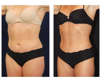 Liposuction before 286777