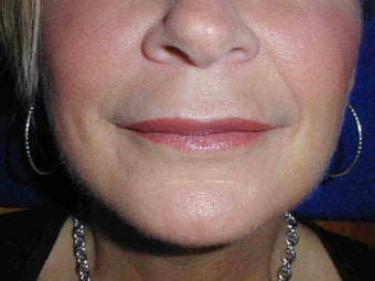 Juvederm to upper lip after 108815