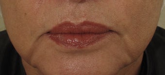 Juvéderm before 378949