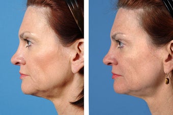 Fillers and Botox Cosmetic 356475