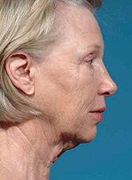 Facelift, eyelid surgery, neck & brow lift 458802