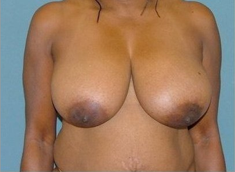 Breast Reduction before 97010