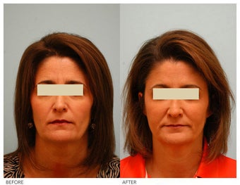 Injectable Fillers (Restylane/Perlane) before 136772