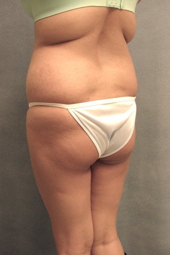 Buttock augmentation and liposculpture before 88874