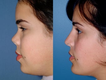 Revision rhinoplasty after 334261