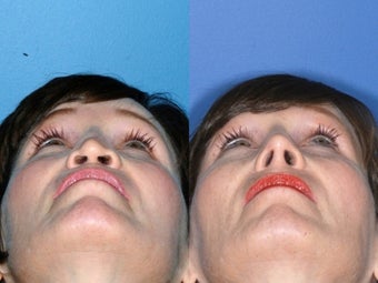 Revision rhinoplasty 334236