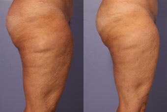 Cellulaze before 607928