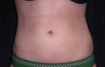 Smartlipo after 512652