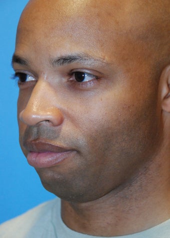 Chin implant before 199376