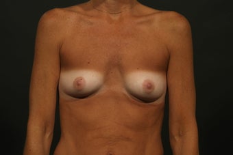 Breast Augmentation before 291229