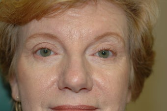 Cheek augmentation with cheek lift, ptosis repair, and elimination of festoons after 341472