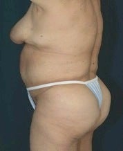 Body Lift after 634983