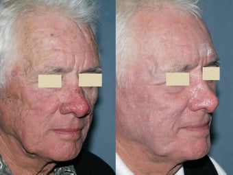 Fraxel repair in conjunction with multiple lasers before 104296