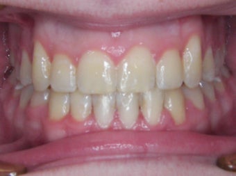 Damon Braces after 378589