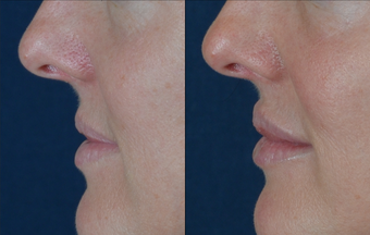 Lip Augmentation before 511369