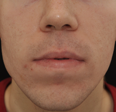 Acne Scarring after 426025