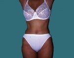 Tummy Tuck after 542650