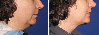 Chin / Neck Liposuction after 342954