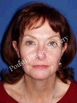 Eyelid Surgery (Blepharoplasty), Face Lift before 636495