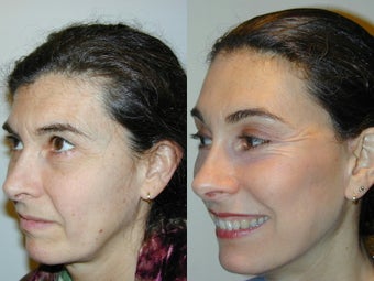 Full Facelift - Browlift, upper and lower blepharoplasty, Lower Facelift after 139168