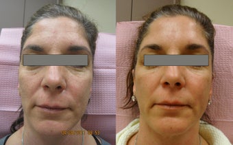 Fractional Erbium Laser Skin Resurfacing before 363698