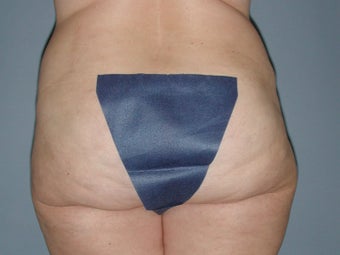 Liposuction hips, waist, upper and lower abdomen, lateral thighs 581418