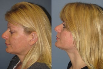 Lite Lift™ before 523709