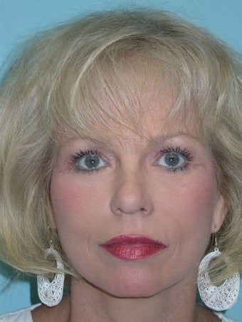 Full Facial Rejuvenation after 148572