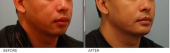 Lip Reduction for Correction of Silicone before 361407