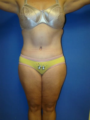 Abdominoplasty Surgery after 151308