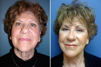 Facelift and periorbital Fat Transfer before 328470
