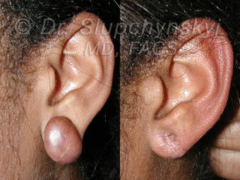 Keloid Removal before 613865