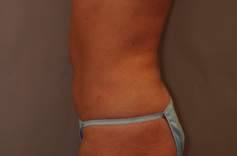 Tummy Liposuction after 229692