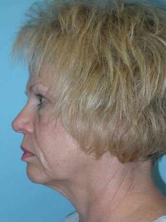 Full Facial Rejuvenation before 148575