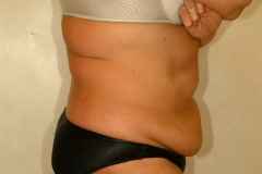Lipo-abdominoplasty before 87342