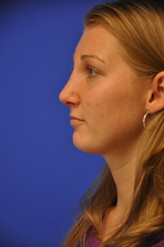 Revision Rhinoplasty after 478750