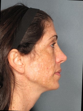 Premier Perfecting Peel before 429579