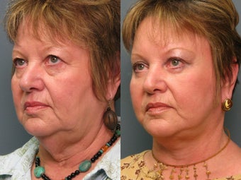 Brow Lift before 338628